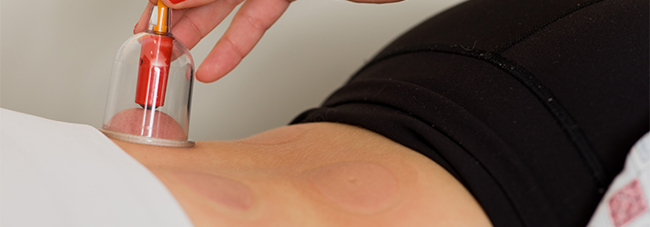 Chiropractic Belleview TN Dixon Center Cupping Chiropractic Belleview TN Dixon Center Cupping